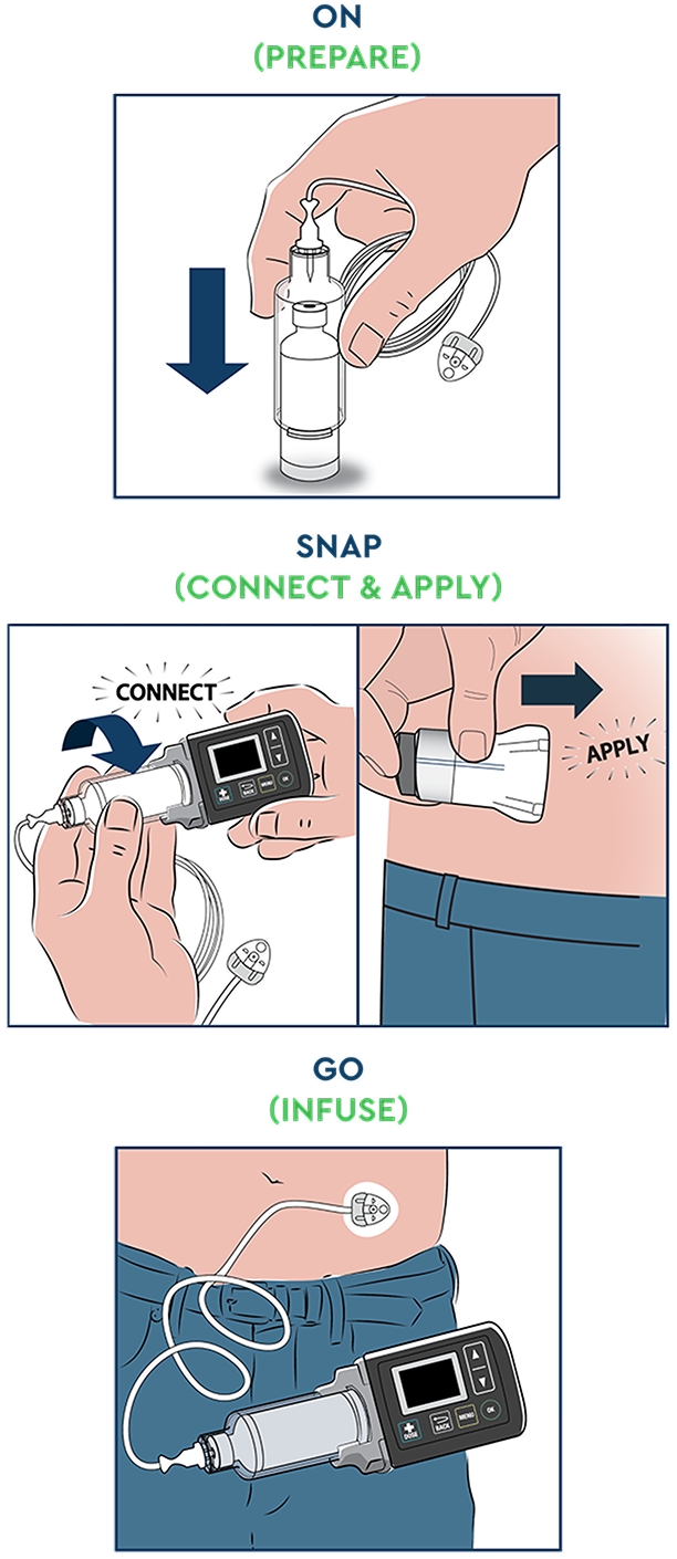 A diagram showing how to administer ONAPGO, a Parkinson’s disease treatment device: on (prepare), snap (connect and apply), go (infuse)